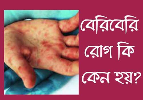 বেরিবেরি রোগ কেন হয়