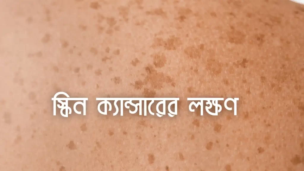 স্কিন ক্যান্সারের লক্ষণ