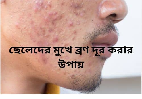 ছেলেদের মুখে ব্রণ দূর করার উপায়